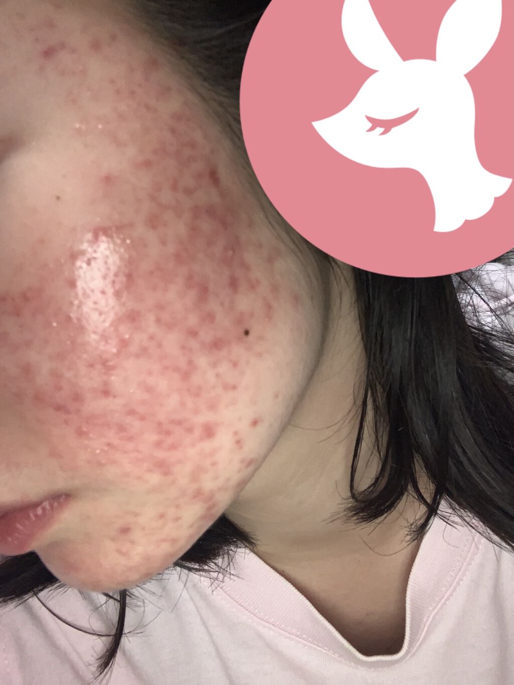 CHOI薬用マスク ニキビケア ［医薬部外品］/肌美精/シートマスク・パックを使ったクチコミ（2枚目）