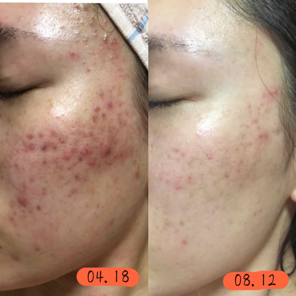 アベンヌ ウオーター アベンヌを使った口コミ ２枚目以降 閲覧注意 汚い肌お見せし By とろろこんぶ 代前半 Lips