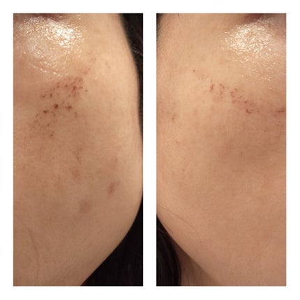 あにゃにゃ♡フォロバ100♡ on LIPS 「11/12に4回目のフォトシルクプラス(シミ取り)を受けてきま..」(4枚目)