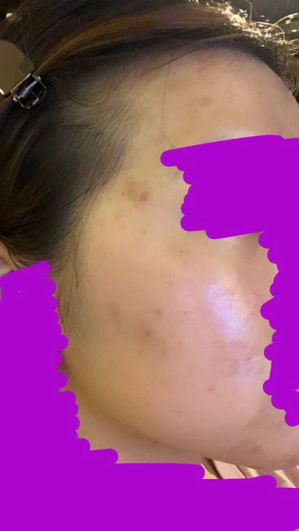 ベピオゲル/マルホ株式会社/その他を使ったクチコミ(2枚目)