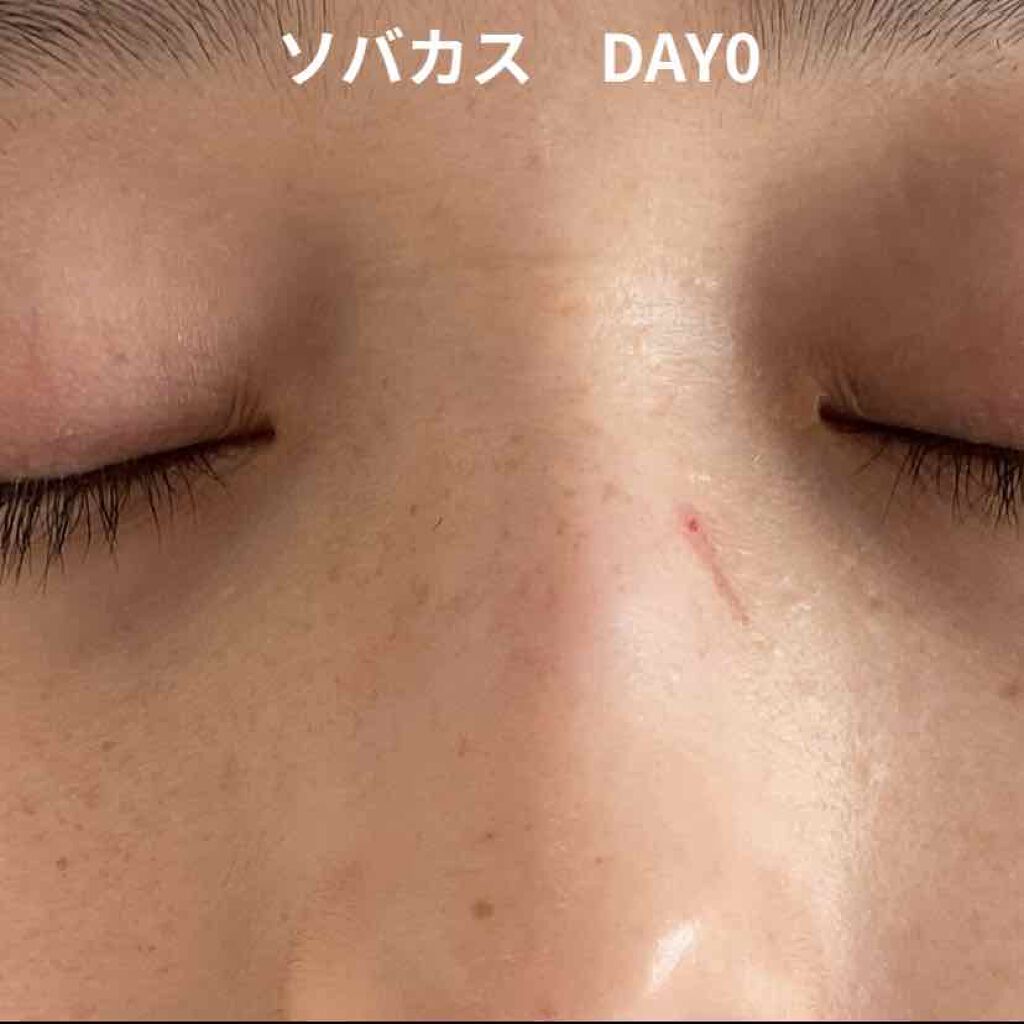 ハイチオールCホワイティア(医薬品)/ハイチオールC/その他を使ったクチコミ（2枚目）