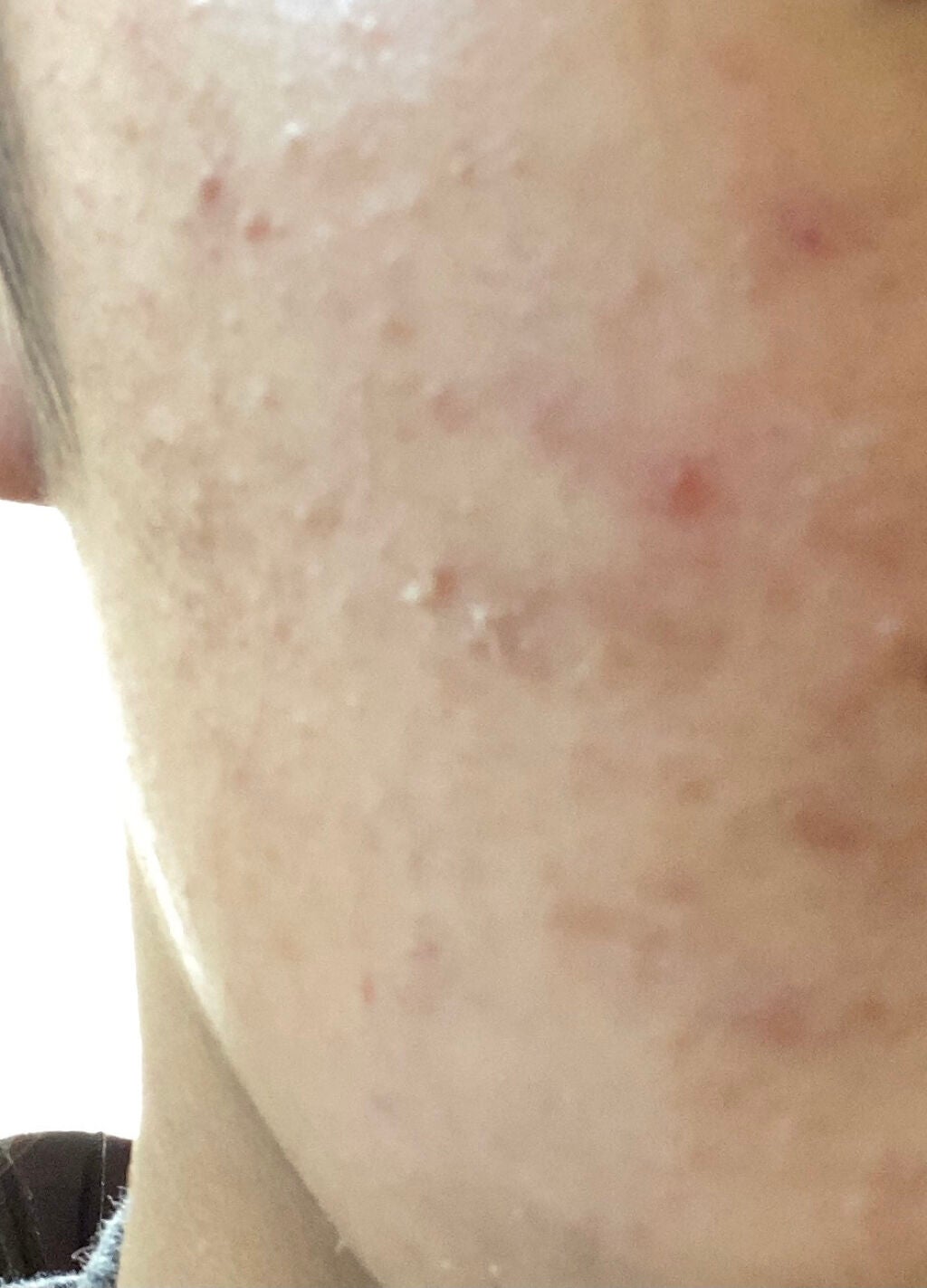 Cherry on LIPS 「初投稿です!!汚い肌晒してしまいすみません、、。この肌治す方法..」(2枚目)