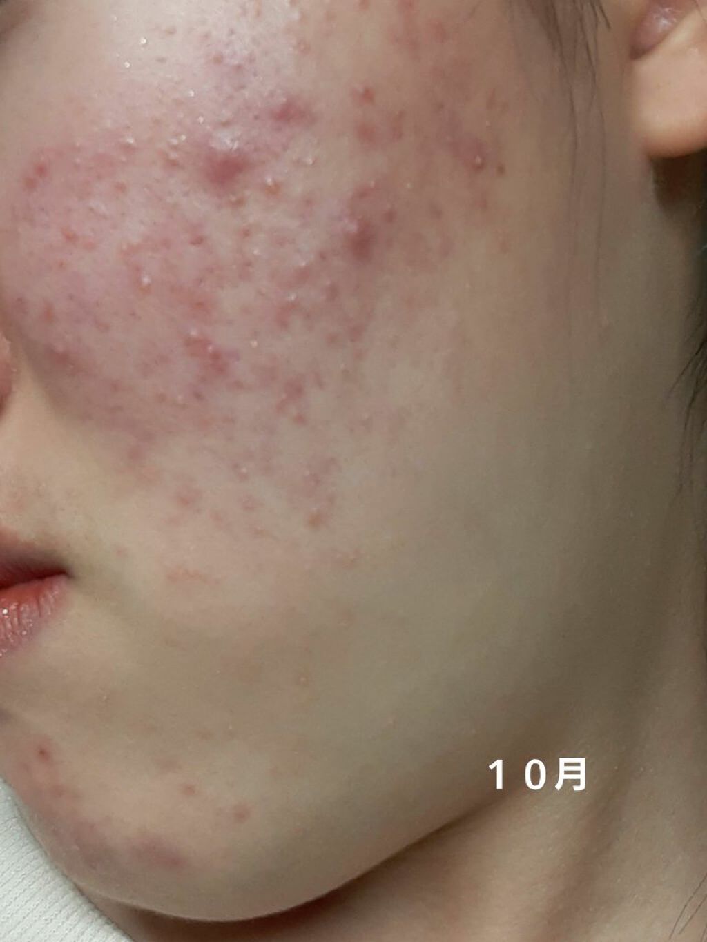 トラブルリペア リキッド/アルージェ/美容液を使ったクチコミ（2枚目）