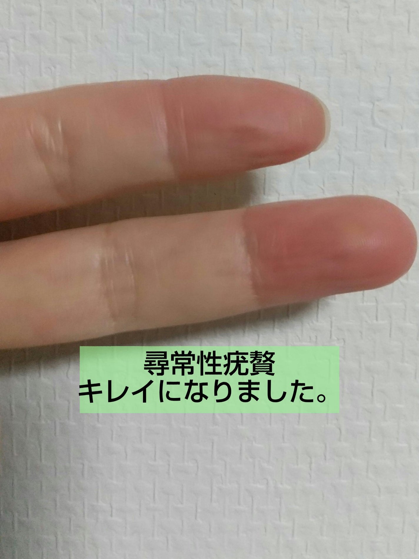 fantastic_gloss on LIPS 「前に投稿した、尋常性疣贅。つまりイボ。皮膚科の通院が終わりまし..」(1枚目)