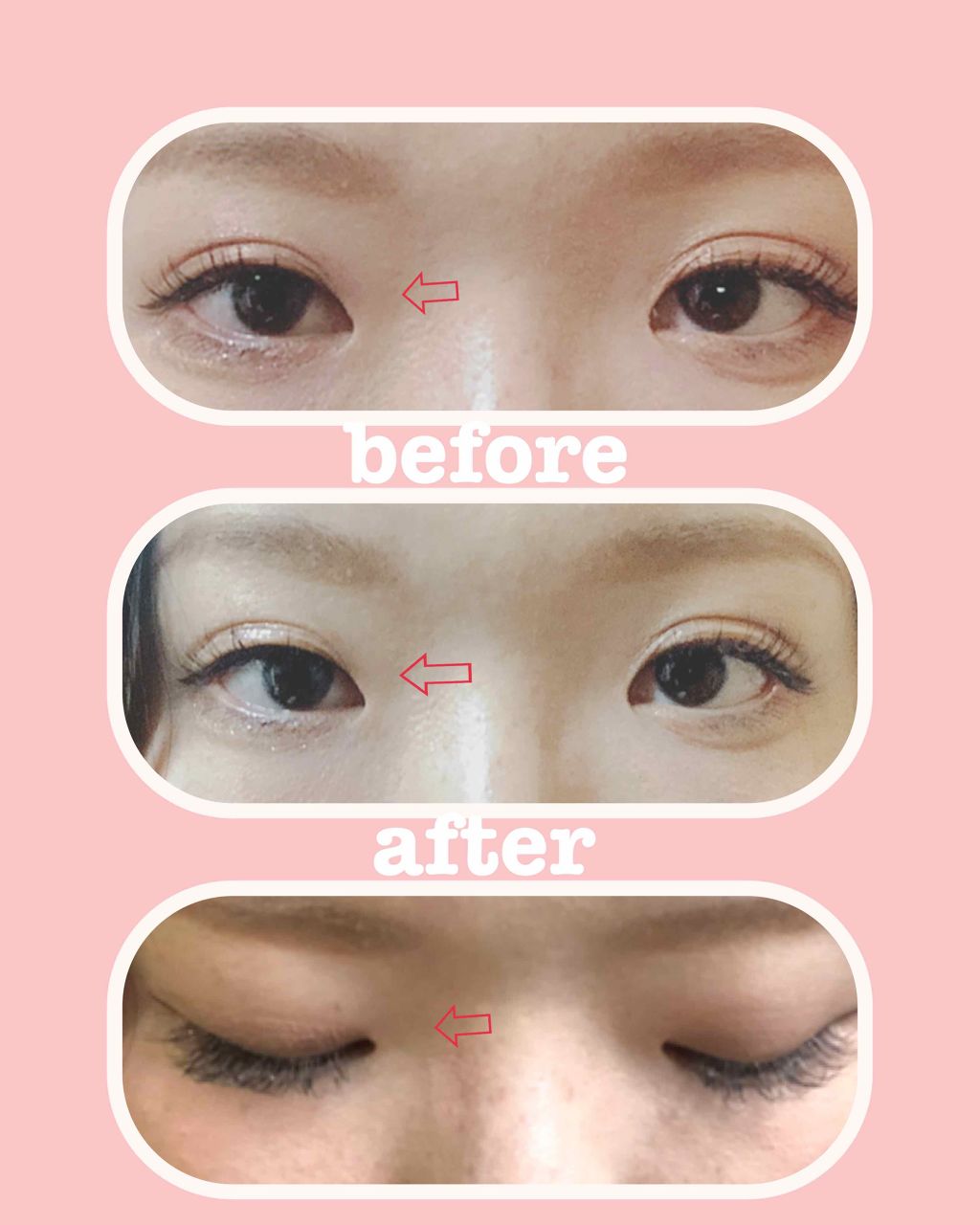 リキッドフィルム/ラクオリ/二重まぶた用アイテムを使ったクチコミ(2枚目)