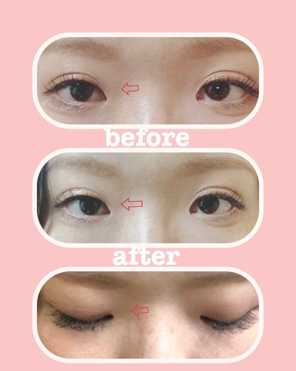 リキッドフィルム/ラクオリ/二重まぶた用アイテムを使ったクチコミ(2枚目)