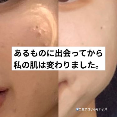 あずき on LIPS 「こんにちは。あずきです。本日は私のお肌を劇的に変えてくれたスキ..」（1枚目）