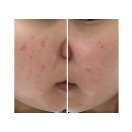 ぽむ on LIPS 「2023.9.13皮膚科に受診 エピデュオとヘパリン処方1枚目..」(5枚目)