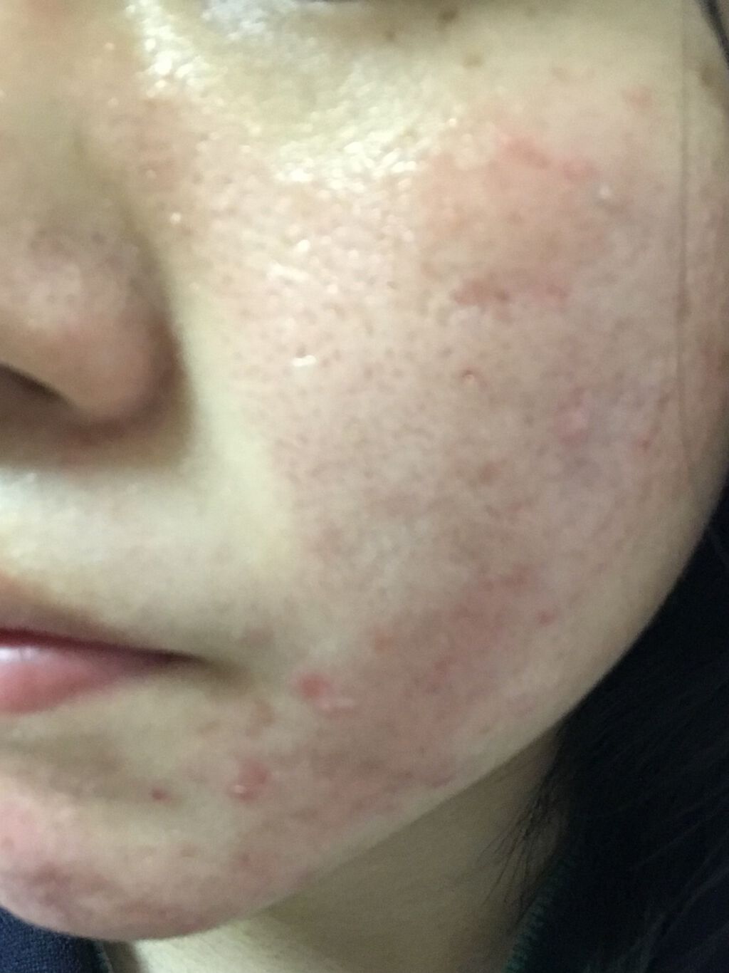 エピデュオゲル/マルホ株式会社/その他を使ったクチコミ（2枚目）