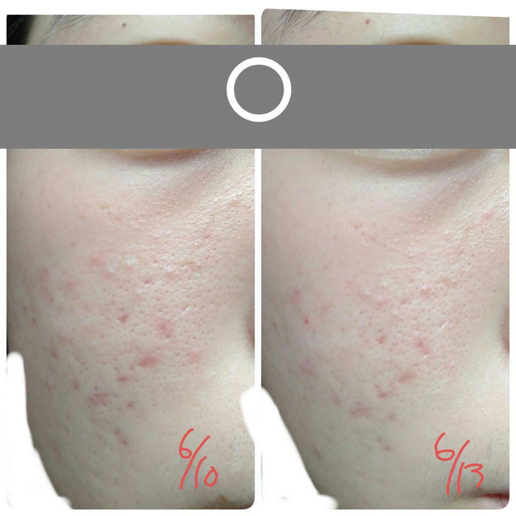 ティーツリーケア ソリューション エッセンシャルマスクEX/MEDIHEAL/シートマスク・パックを使ったクチコミ（2枚目）