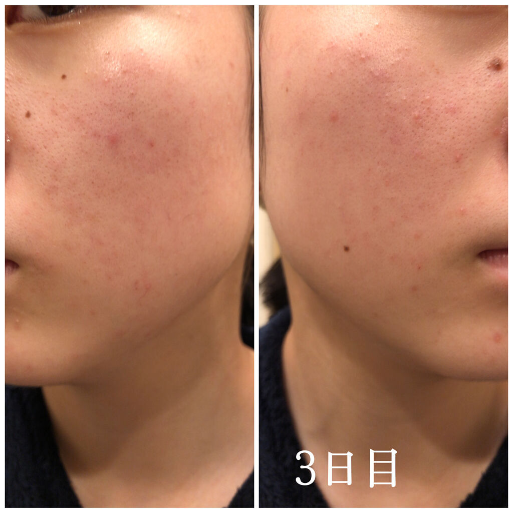 DHC はとむぎエキス/DHC/健康サプリメントを使ったクチコミ（2枚目）