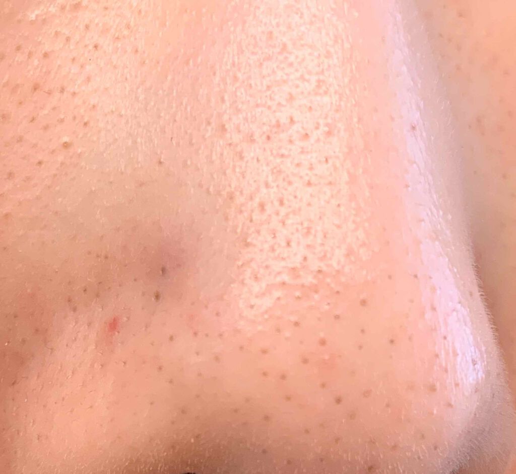 ぴっぴ on LIPS 「アイメイクから一転、またまた汚肌降臨致しました。ぴっぴと申しま..」(3枚目)