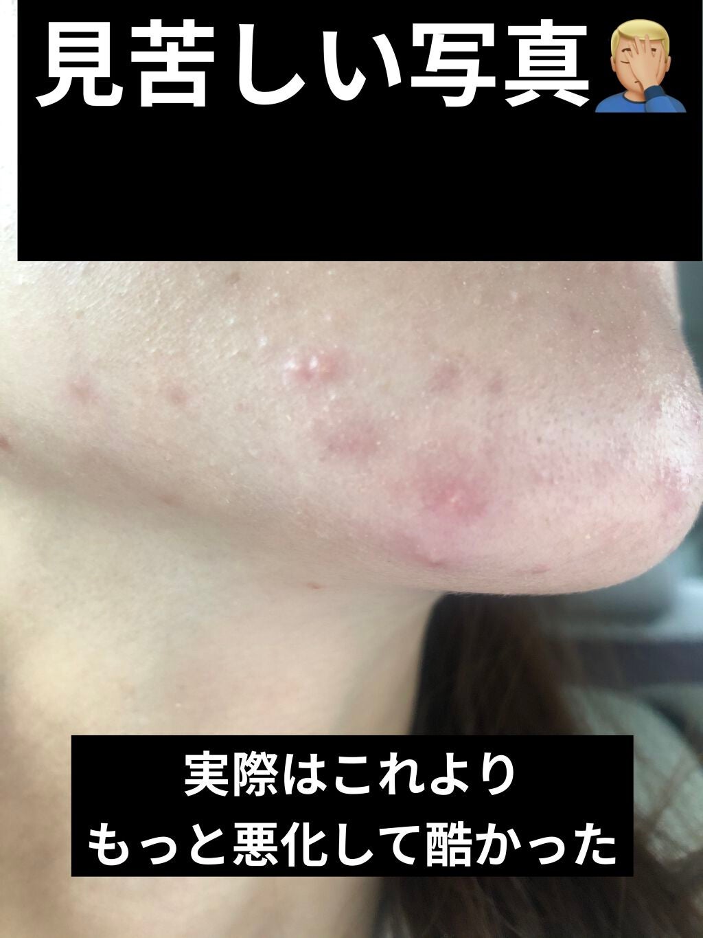 DRX AZAクリア/ロート製薬/その他スキンケアを使ったクチコミ(2枚目)