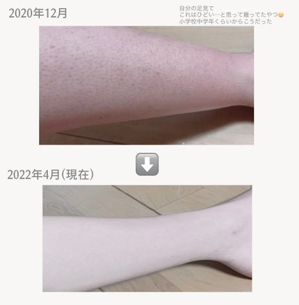 ケアノキュア(医薬品)/小林製薬/その他を使ったクチコミ(2枚目)
