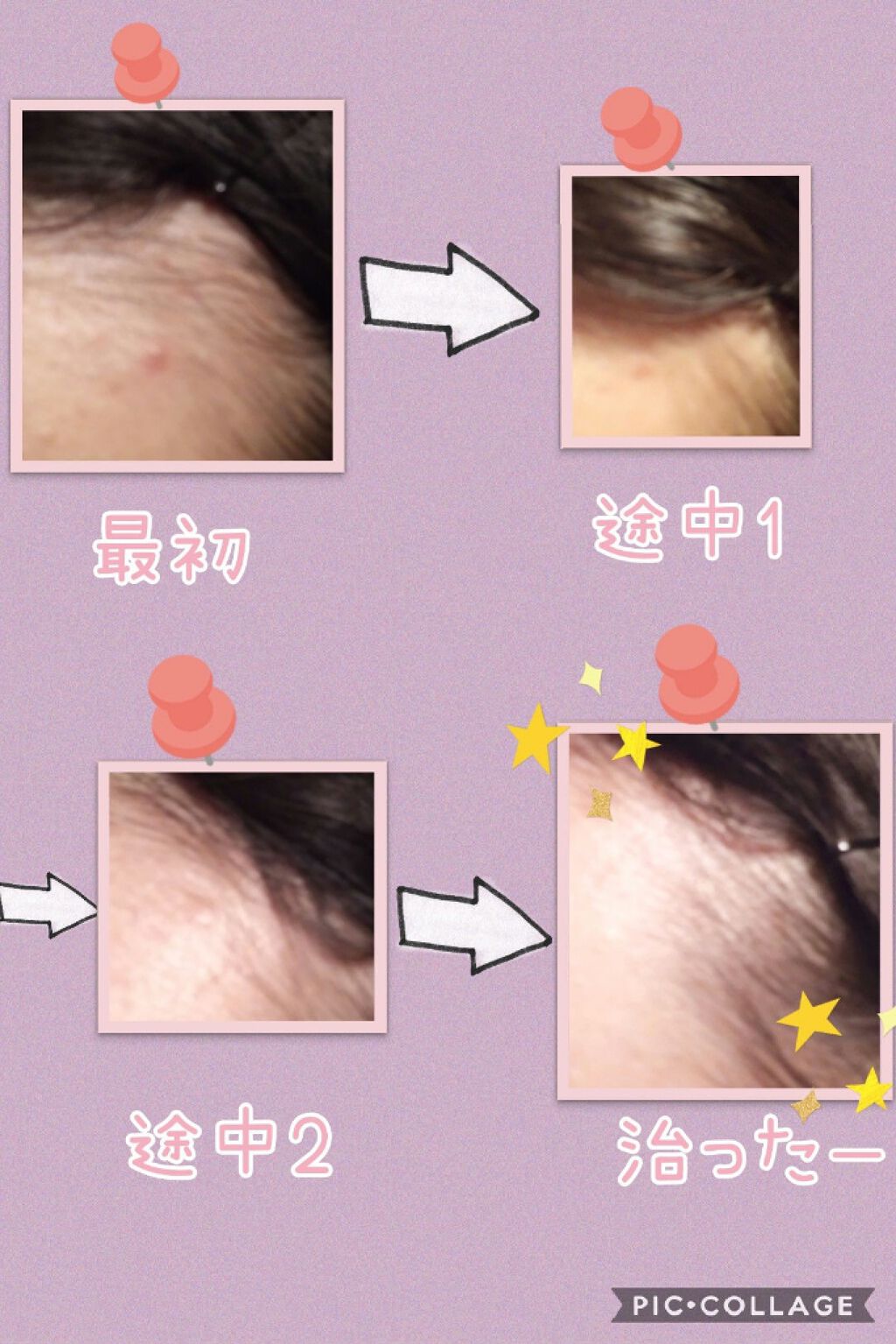 オロナインＨ軟膏 (医薬品)/オロナイン/その他を使ったクチコミ（2枚目）