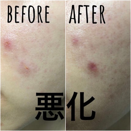 ニキビあとケアジェル/アットノン/その他スキンケアを使ったクチコミ(5枚目)