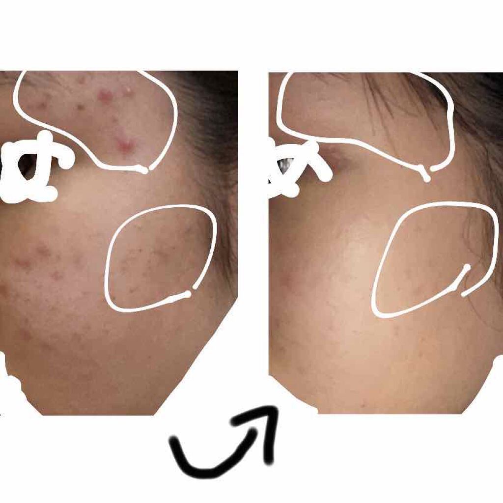 さく on LIPS 「1週間でいきなり現れたニキビをおさめました。さくです💨私は中学..」(2枚目)