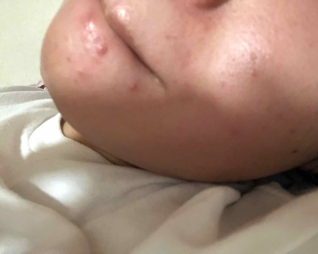 ロゼット洗顔パスタ アクネクリア/ロゼット/洗顔フォームを使ったクチコミ（1枚目）