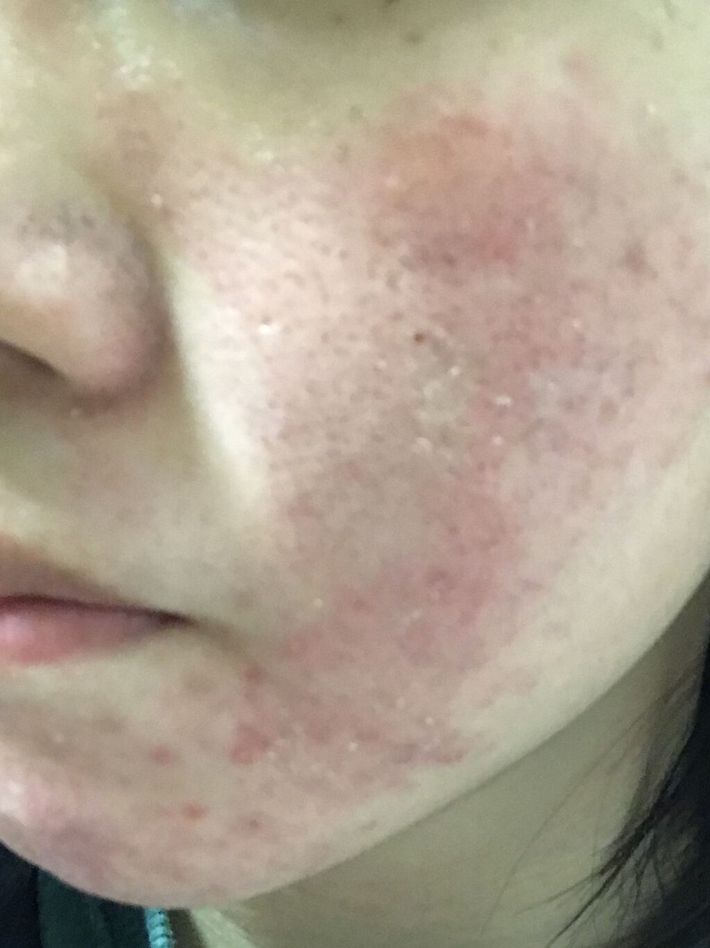 エピデュオゲル/マルホ株式会社/その他を使ったクチコミ（2枚目）