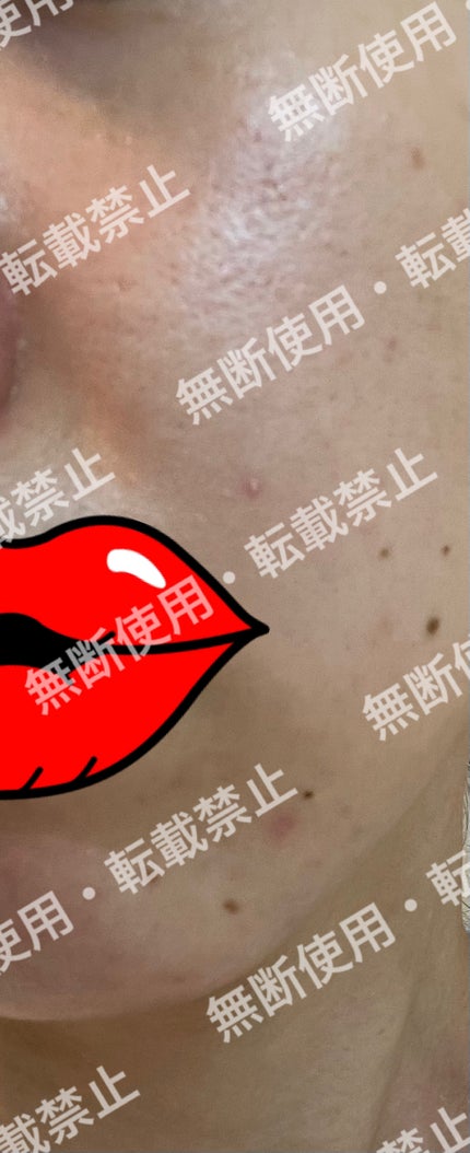 colorful_perfume_r39m on LIPS 「まずこれを初期の肌の状態写真とします。※自分的に肌が1番汚く見..」(5枚目)