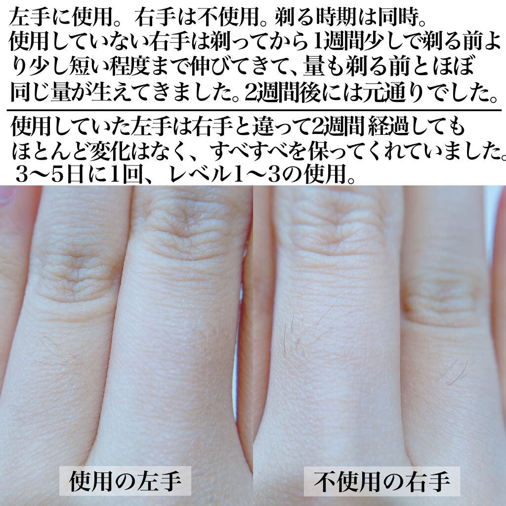 光美容器 光エステ ボディ&フェイス用 ハイパワー ゴールドES-CWP97-N/Panasonic/家庭用脱毛器を使ったクチコミ(4枚目)