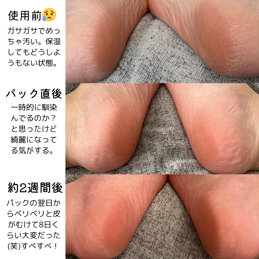 イージーパックDP60分タイプ 60分タイプ Sサイズ/ベビーフット/レッグ・フットケアを使ったクチコミ（2枚目）