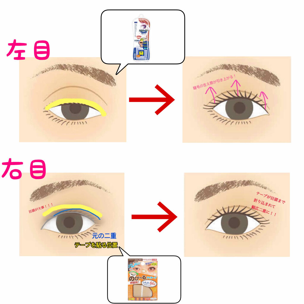 ワンダーアイリッドテープ Extra/D-UP/二重まぶた用アイテムを使ったクチコミ（3枚目）
