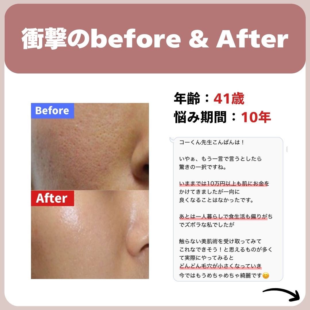 あなたの肌に合ったスキンケア💐コーくん先生 on LIPS 「【本当は教えたくない】エグいほど毛穴消える方法🤫..あなたの毛..」(3枚目)