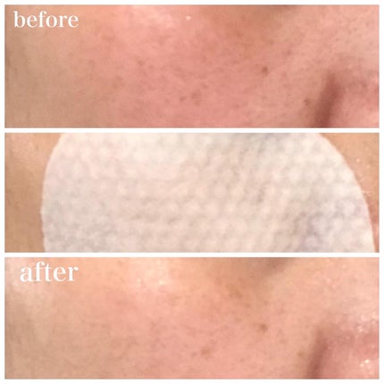 ピーリングパッド ポアノ/ウツクシア/トナーパッドを使ったクチコミ(5枚目)