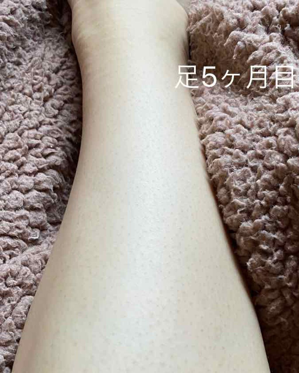 光脱毛器 VIO/Sarlisi/家庭用脱毛器を使ったクチコミ（1枚目）