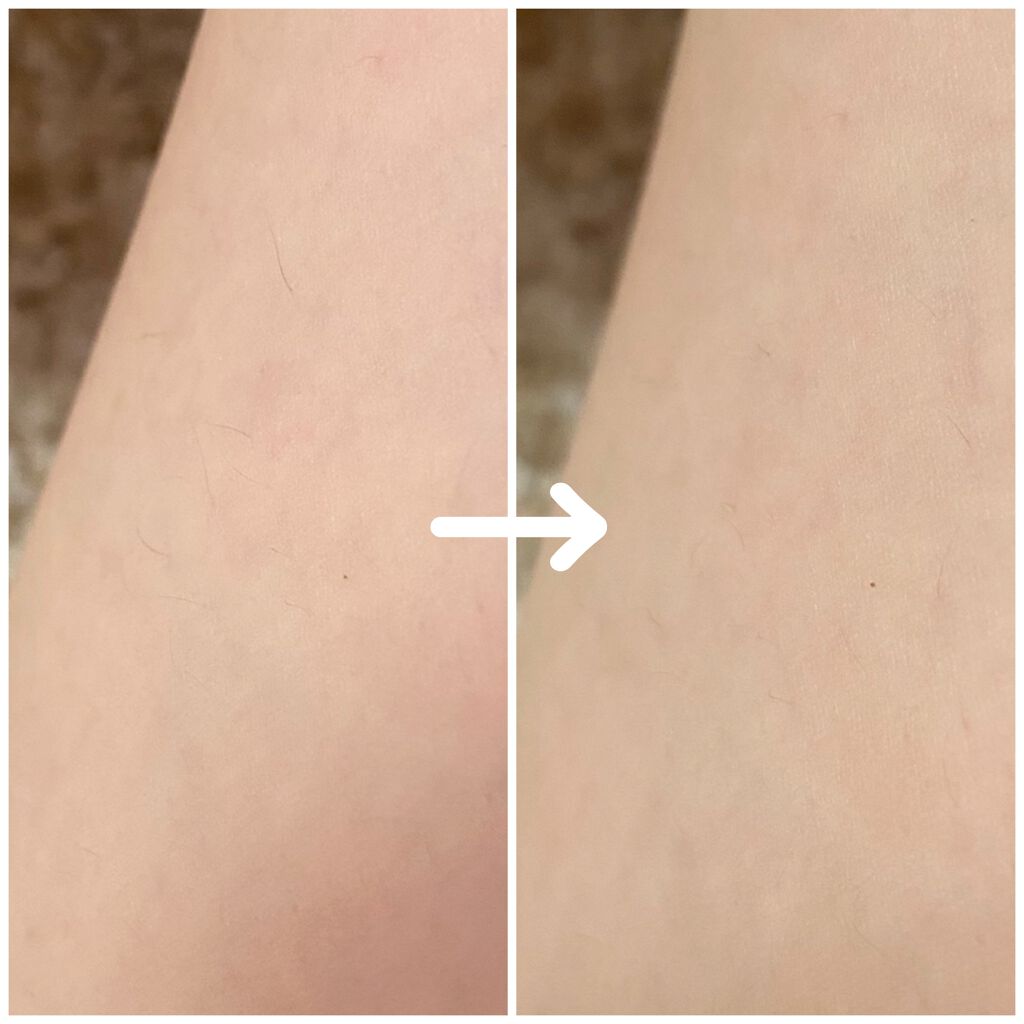 光美容器KE-NON(ケノン)/エムテック/家庭用脱毛器を使ったクチコミ(3枚目)