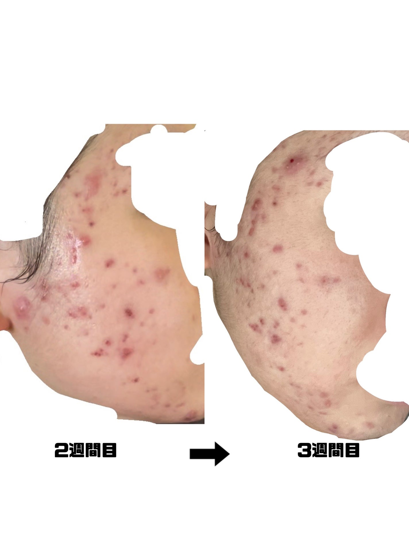 みこ on LIPS 「【ニキビ治療経過記録】閲覧注意です!!エピデュオゲルやその他も..」(3枚目)