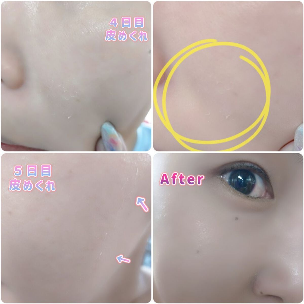 ダーマスキンピーリング/BQCELL/その他キットセットを使ったクチコミ(7枚目)