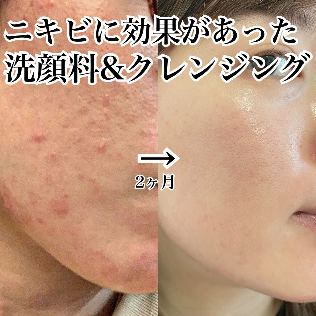 かき©︎ on LIPS 「《人生最悪のニキビに悩まされていたときに効果を感じた洗顔料&ク..」(1枚目)
