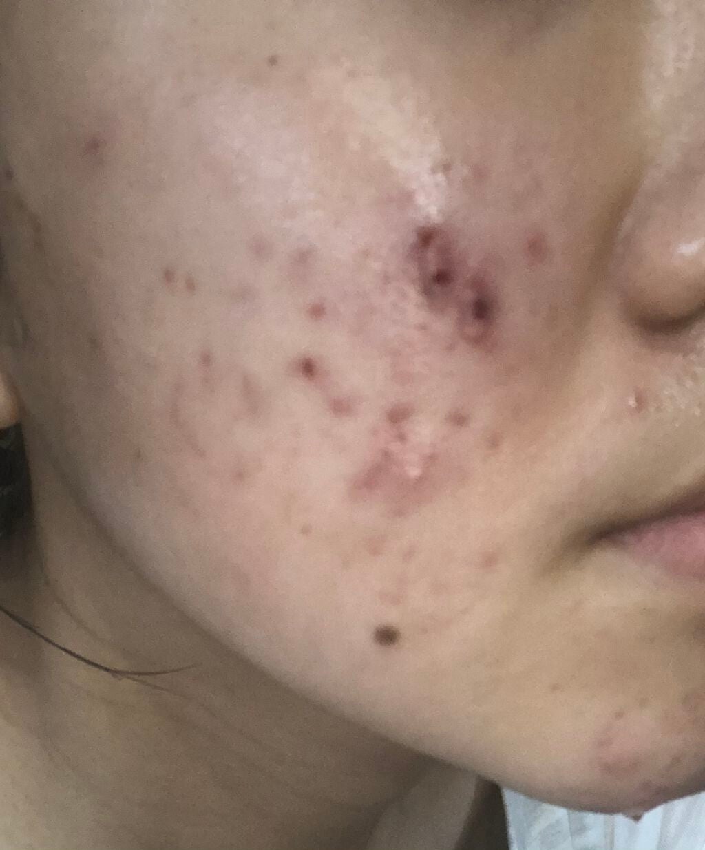 ❤︎𝐑𝐄𝐈𝐊𝐀❤︎ on LIPS 「最近ニキビに大変悩んでいます。私はニキビが出来たらすぐ潰してし..」(2枚目)