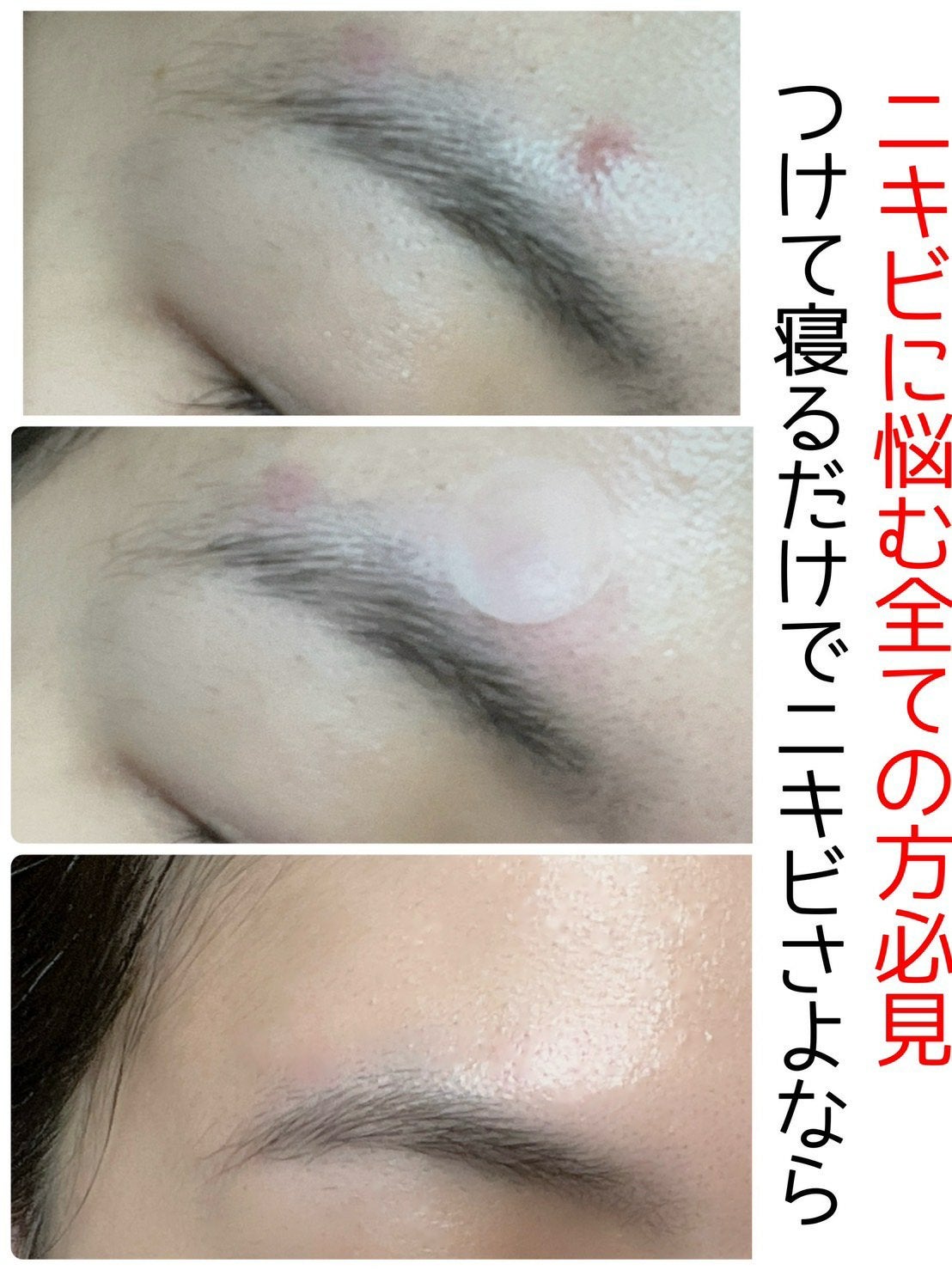 ビューティー スポットパッチ/イージーダムビューティー/にきびパッチを使ったクチコミ(1枚目)