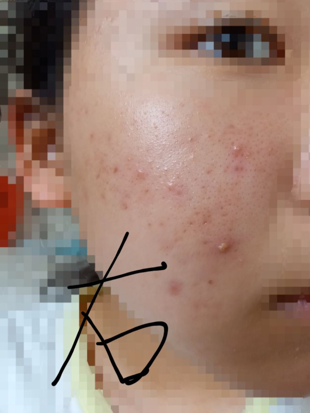 ペアアクネクリーンローション/ペア/化粧水を使ったクチコミ（3枚目）