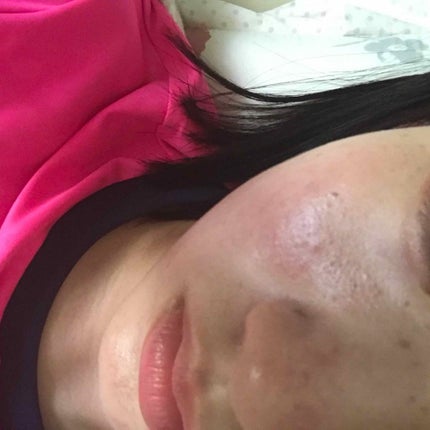 ケアアクネ 薬用 ジェルスポッツ/ナリス化粧品/美容液を使ったクチコミ(1枚目)