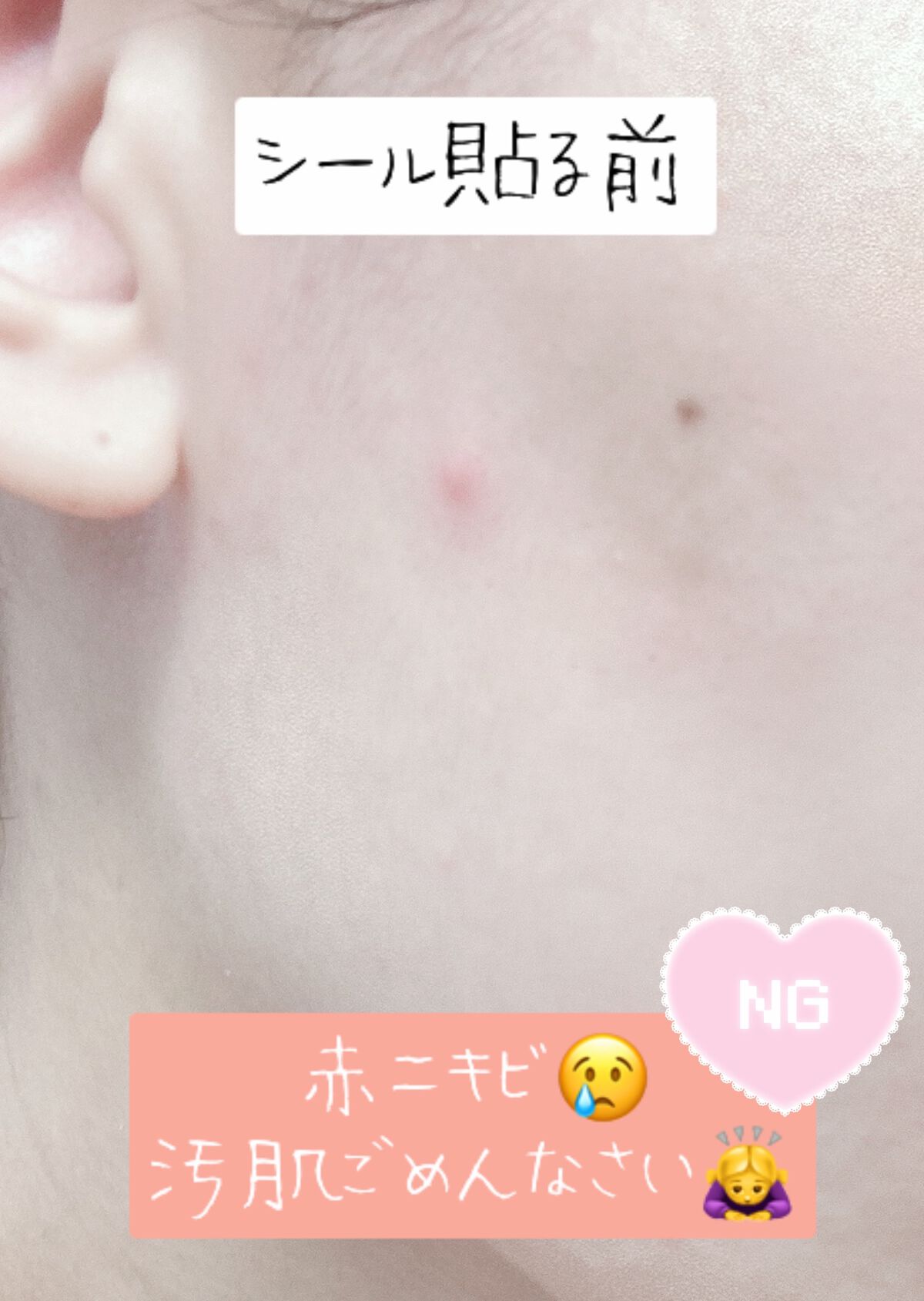 プロCICA クリアスポットパッチ/VT/その他スキンケアを使ったクチコミ(4枚目)