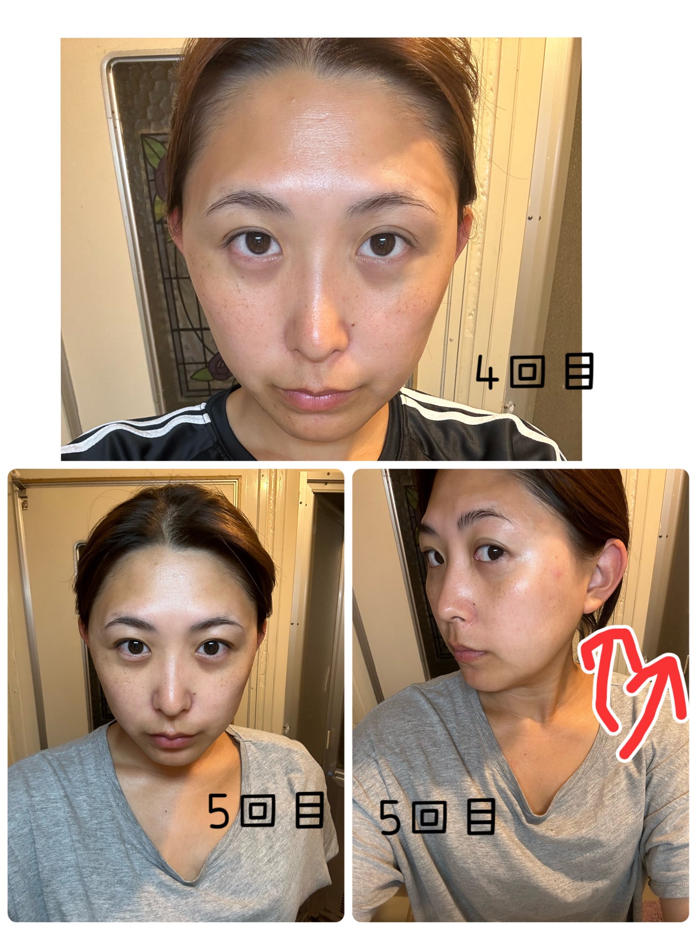 リマージ糸リフティングアンプル/REVENIP/美容液を使ったクチコミ(3枚目)