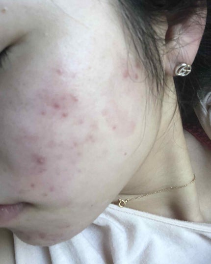 orange_perfume_2opm on LIPS 「おはようございます🌞塗り始めて2日目の朝です。すこーし痒みが出..」(4枚目)