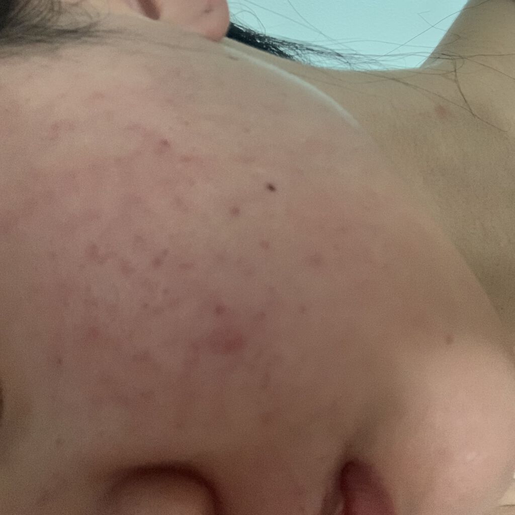 ディフェリンゲル0.1% /マルホ株式会社/その他を使ったクチコミ（1枚目）