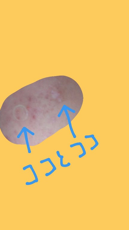 プロCICA クリアスポットパッチ/VT/その他スキンケアを使ったクチコミ(3枚目)