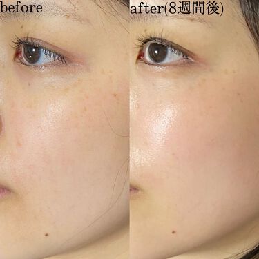 試してみた】トリア・スキン エイジングケアレーザー/トリア | LIPS 格安アウトレット トリア アイケアレーザー 美容機器