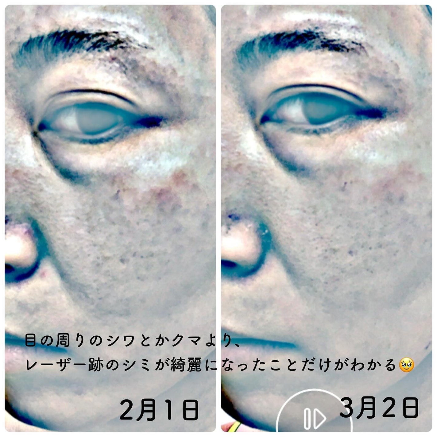 Cemenrete Calcium Intense Cream/Dr.Melaxin/フェイスクリームを使ったクチコミ(6枚目)