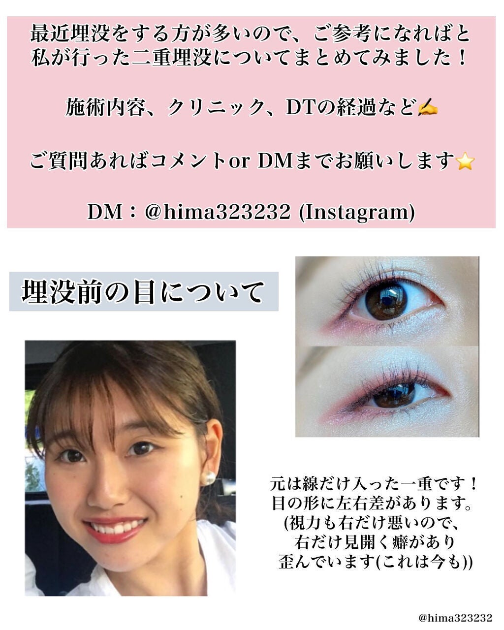 ひまちゃん /垢抜けの参考書 on LIPS 「【整形】〜私が施術した二重埋没について〜本日は!1年半くらい前..」(2枚目)