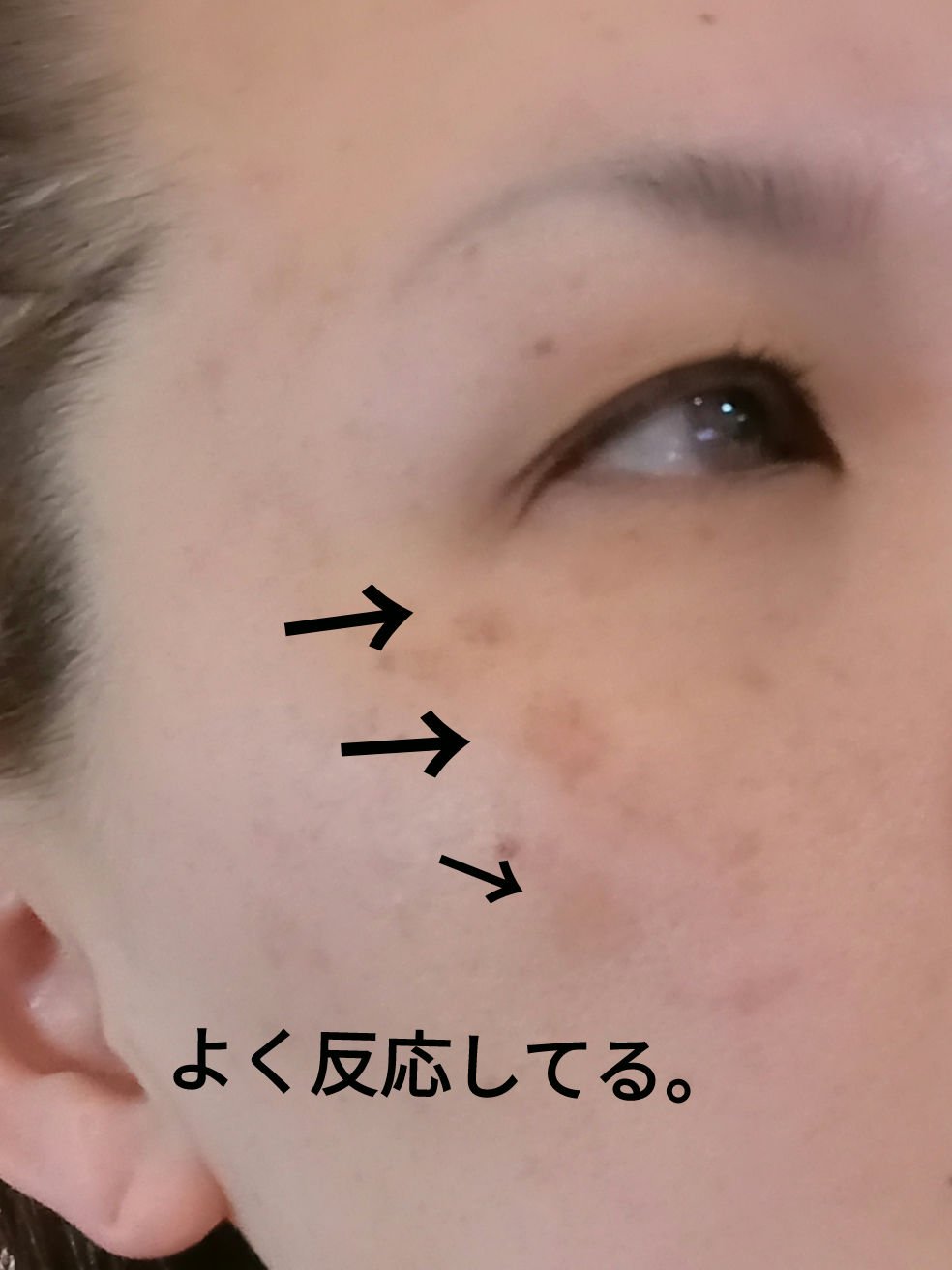 フォトダブル/湘南美容クリニック/その他を使ったクチコミ（2枚目）