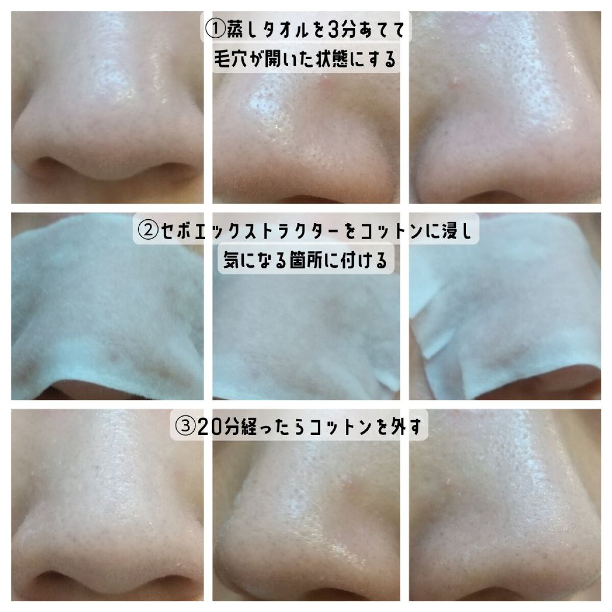 アクレオンセボエクストラクター/ANACIS/その他スキンケアを使ったクチコミ（3枚目）