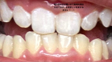 ハニックDC スノー/ハニック・ホワイトラボ/その他オーラルケアを使ったクチコミ(3枚目)