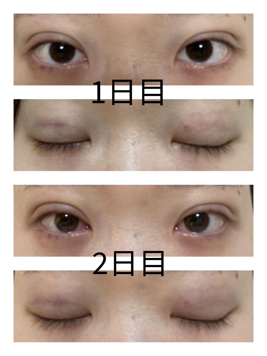 二重整形/その他を使ったクチコミ（2枚目）